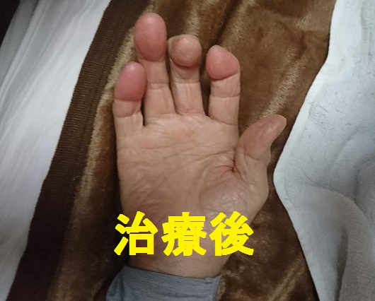 レイノー現象 施術後