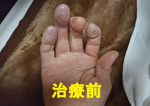 レイノー現象 治療前